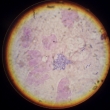 bakteriln infekce moovho mche